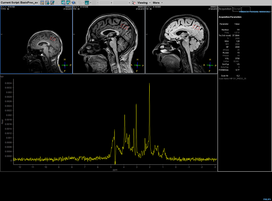 La Resonancia Magnética Cerebral Como Herramienta De Investigación